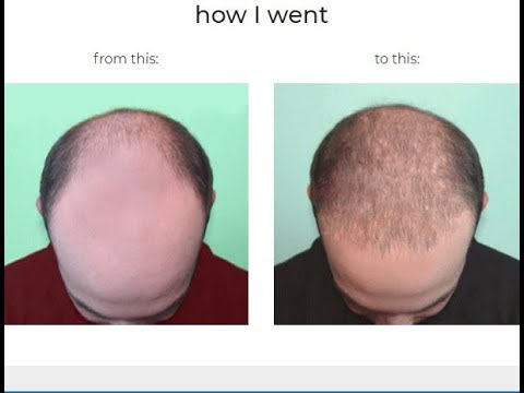 Rebuild Hair Program Review