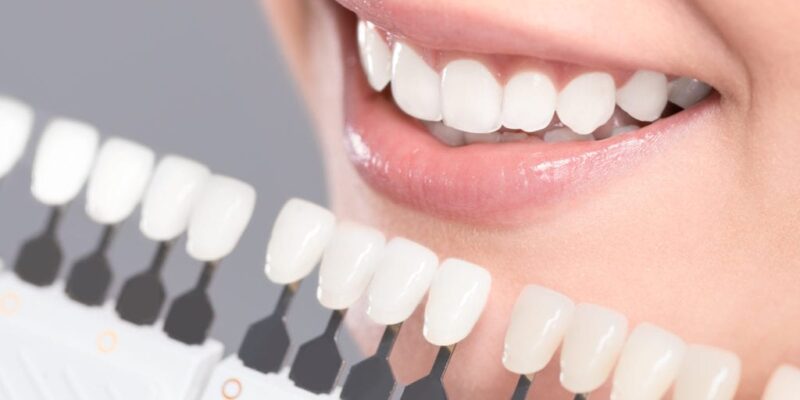 Cosmetic Teeth Whitening Cost
