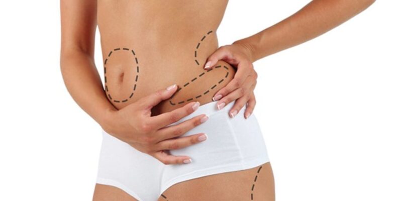 Belly Fat Liposuction Cost