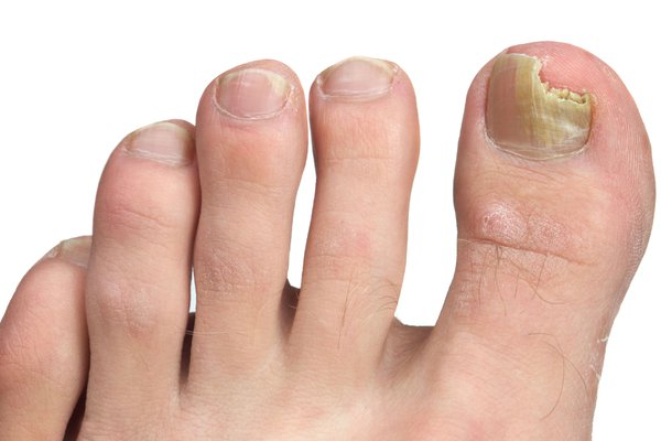 Which Nail Fungus Treatment Works Best