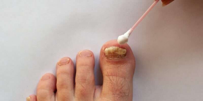 How to Cure Nail Fungus Fast at Home