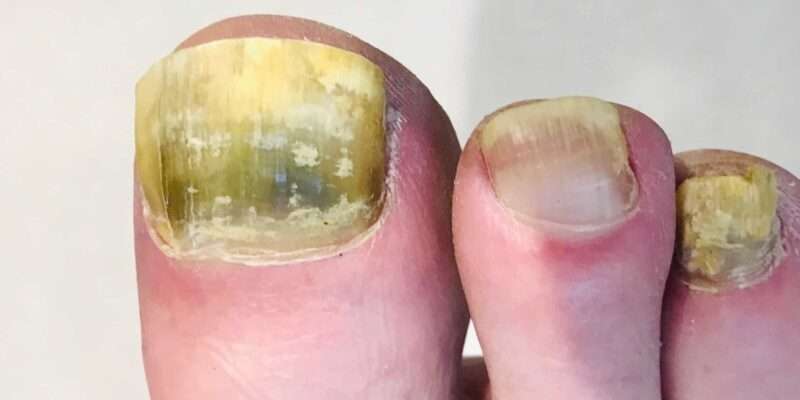 What is the Best Over the Counter Nail Fungus Treatment