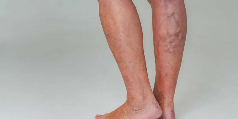 What are the Different Stages of Vein Infection in Human Beings