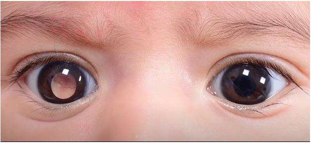 What are the Different Stages of Childhood Eye Cancer