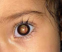 How to Confirm that Your Child has Retinoblastoma