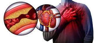 Is Obesity Increasing Your Hypertension Risk