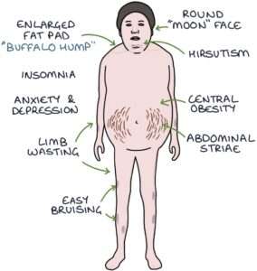 Cushing’s Syndrome and Its Impact on Obesity