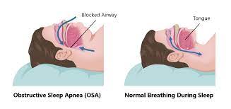 How Fat Deposits in the Neck Worsen Airflow