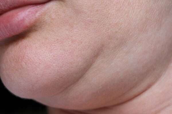 How Obesity Increases Fat Deposits Around Your Neck