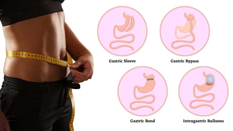 How Bariatric Surgery Promotes Rapid Weight Loss