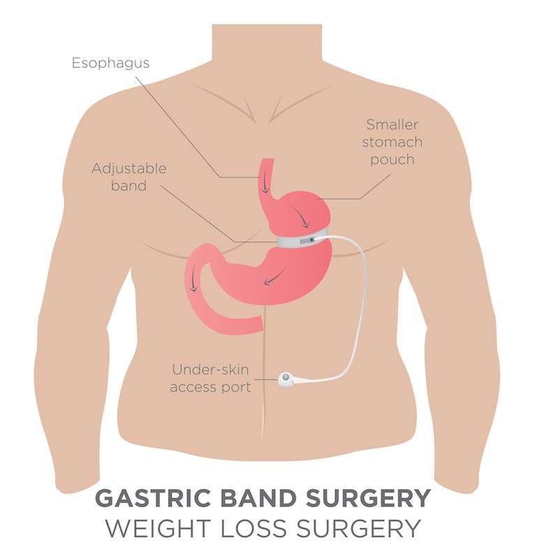 How Bariatric Surgery leads to quick weight loss