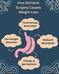 bariatric surgery is backed by medical science