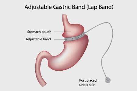 How Adjustable Gastric Bands Aid in Weight Loss