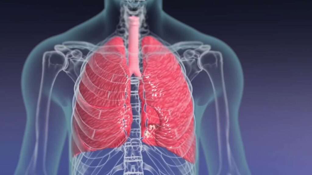 How Obesity Affects Lung Capacity