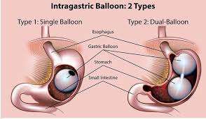 How Gastric Balloons Reduce Food Intake Capacity