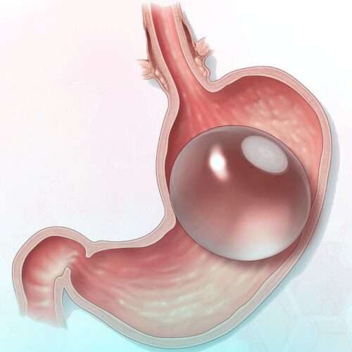 What Is a Gastric Balloon