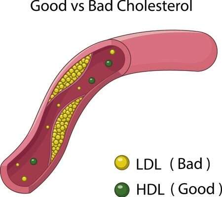 Link Between Obesity and Decreased HDL Cholesterol
