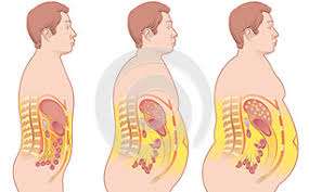 How to Manage Obesity in Little Rock Pulaski County Arkansas